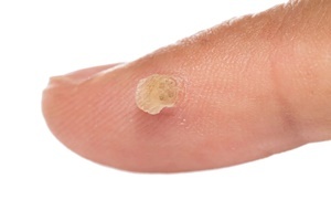 Unha verruga é unha enfermidade de pel que efectivamente loitas Skincell Pro