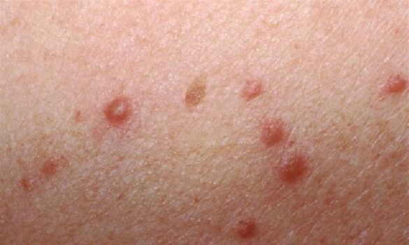 A aparición de papilomas na pel dunha muller