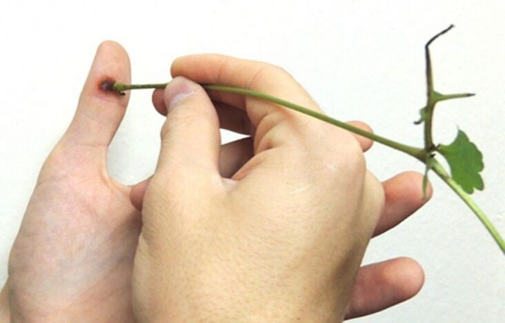 Eliminación dunha verruga no dedo con zume de herbas de celidonia