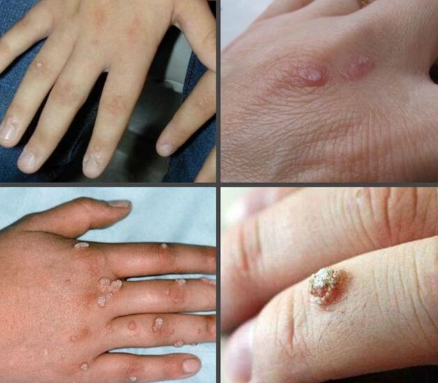 A aparición e localización das verrugas nas mans
