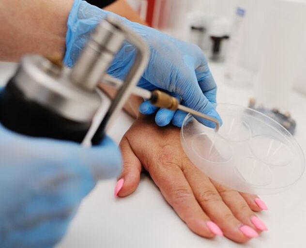 Criodestrución - un método para eliminar as verrugas das mans conxelándoas con nitróxeno líquido