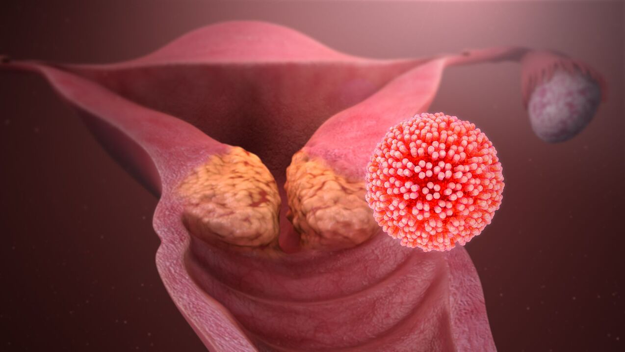 virus do papiloma humano no corpo